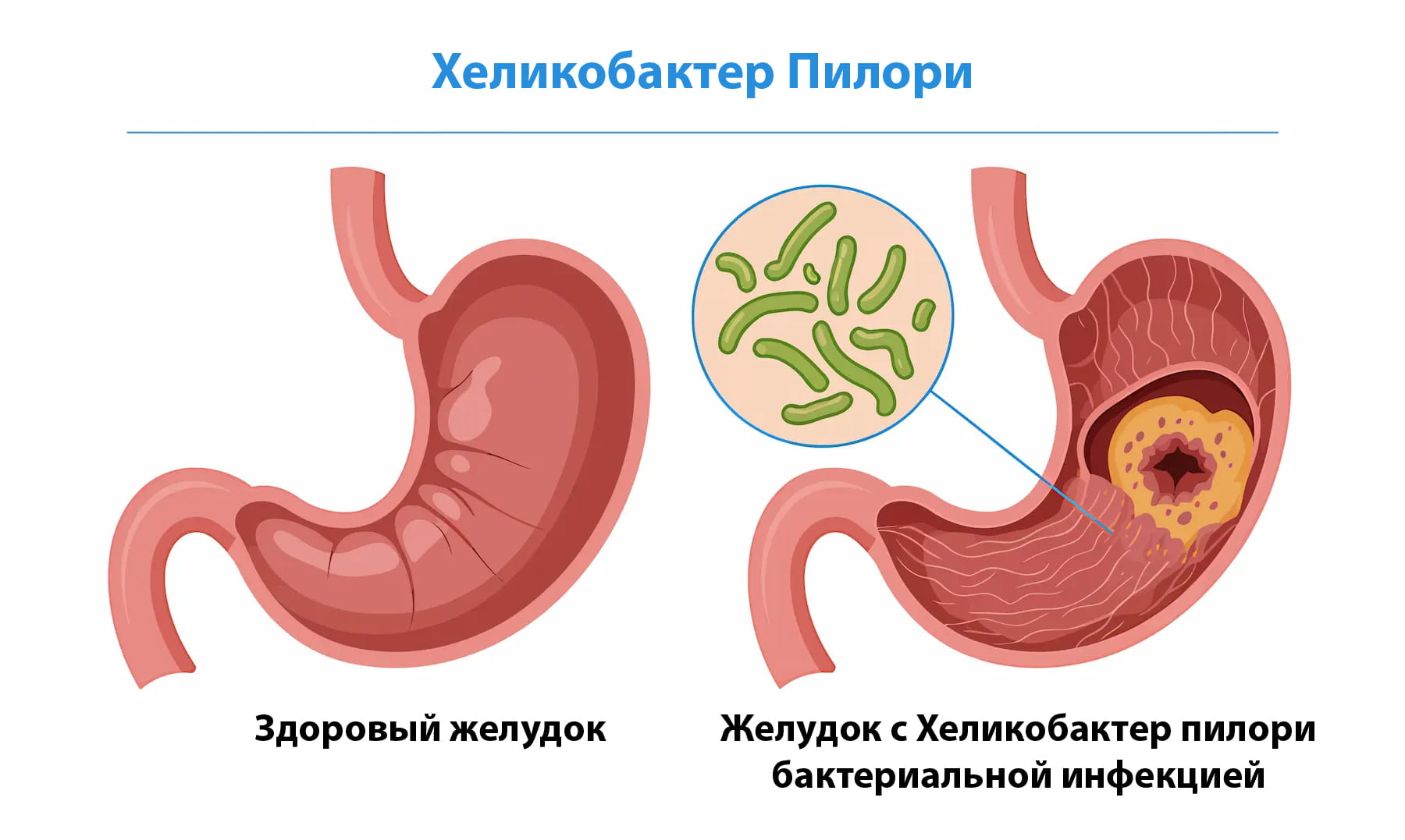 Helicobacter pylori